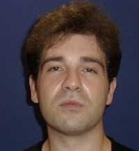 facial implants
